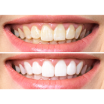 ⁦لصقات تبييض الأسنان من ستيلا وايت - 6 لصقات⁩ - الصورة ⁦2⁩